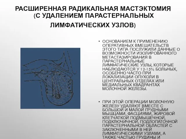 Расширенная радикальная мастэктомия (с удалением парастернальных лимфатических узлов) Основанием к применению оперативных