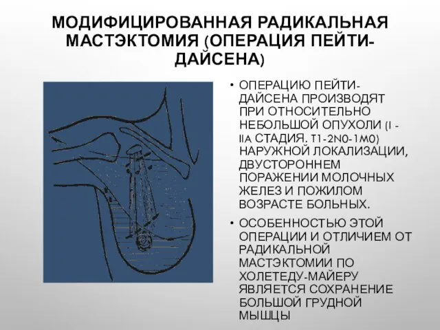 Модифицированная радикальная мастэктомия (операция Пейти-Дайсена) Операцию Пейти-Дайсена производят при относительно небольшой опухоли