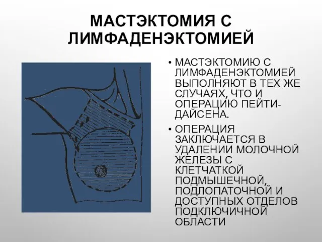 Мастэктомия с лимфаденэктомией Мастэктомию с лимфаденэктомией выполняют в тех же случаях, что