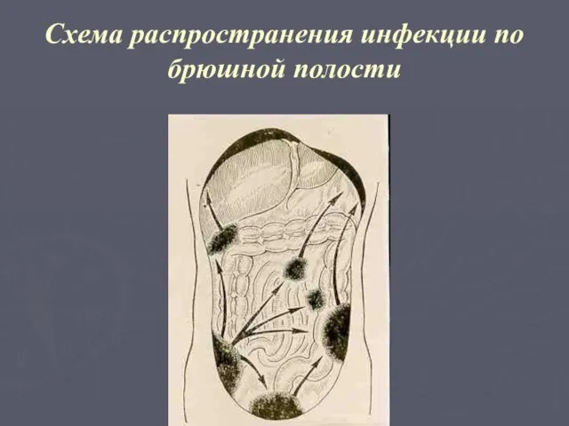 Схема распространения инфекции по брюшной полости