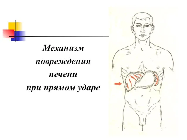 Механизм повреждения печени при прямом ударе