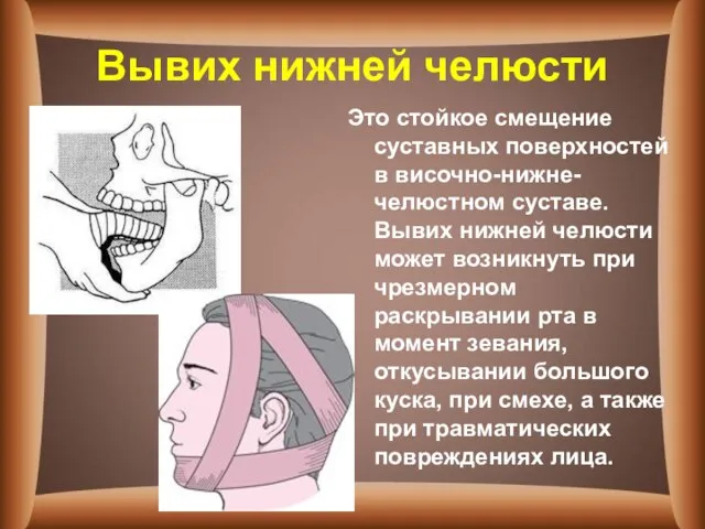 Вывих нижней челюсти Это стойкое смещение суставных поверхностей в височно-нижне-челюстном суставе. Вывих