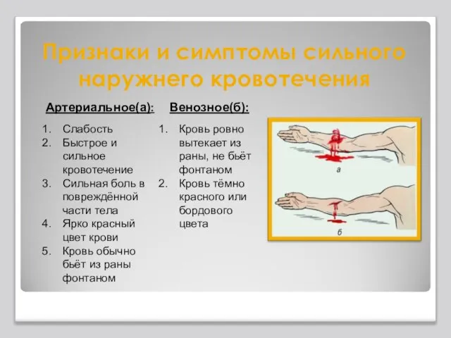 Признаки и симптомы сильного наружнего кровотечения Артериальное(а): Слабость Быстрое и сильное кровотечение