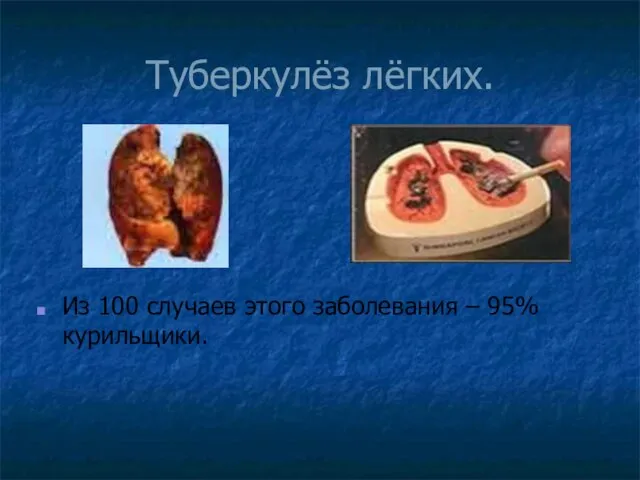 Туберкулёз лёгких. Из 100 случаев этого заболевания – 95% курильщики.