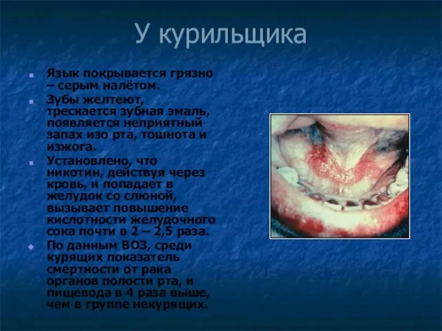 У курильщика Язык покрывается грязно – серым налётом. Зубы желтеют, трескается зубная