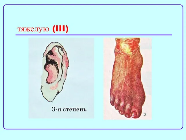 тяжелую (III)