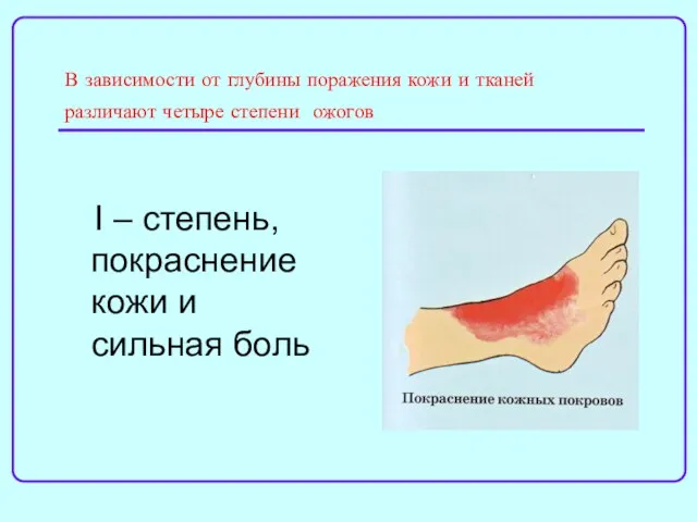 В зависимости от глубины поражения кожи и тканей различают четыре степени ожогов