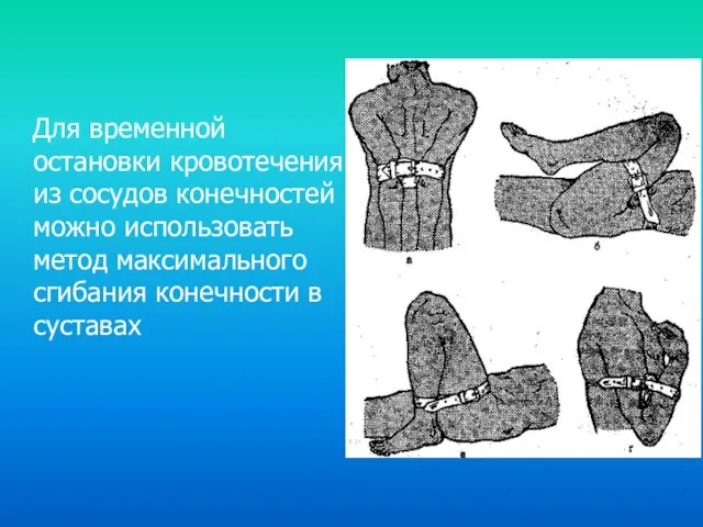 Для временной остановки кровотечения из сосудов конечностей можно использовать метод максимального сгибания конечности в суставах