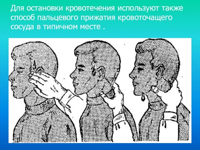 Для остановки кровотечения используют также способ пальцевого прижатия кровоточащего сосуда в типичном месте .