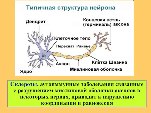 Склерозы, аутоиммунные заболевания связанные с разрушением миелиновой оболочки аксонов в некоторых нервах,