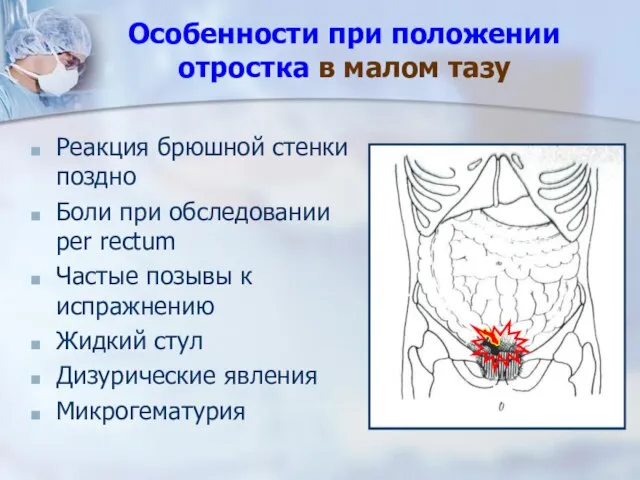 Особенности при положении отростка в малом тазу Реакция брюшной стенки поздно Боли