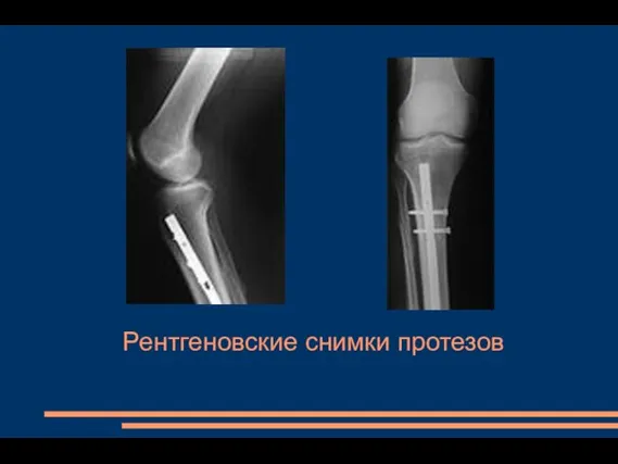 Рентгеновские снимки протезов