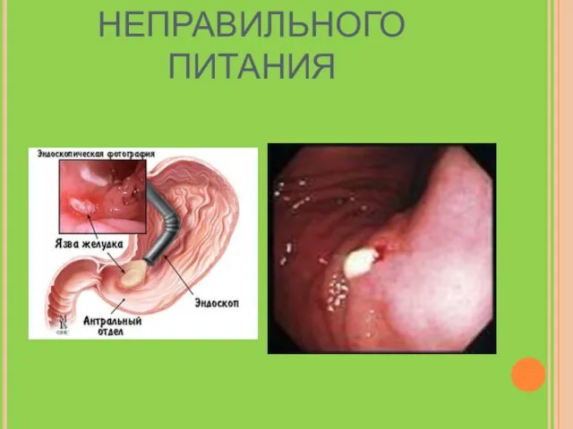 ПОСЛЕДСТВИЯ НЕПРАВИЛЬНОГО ПИТАНИЯ