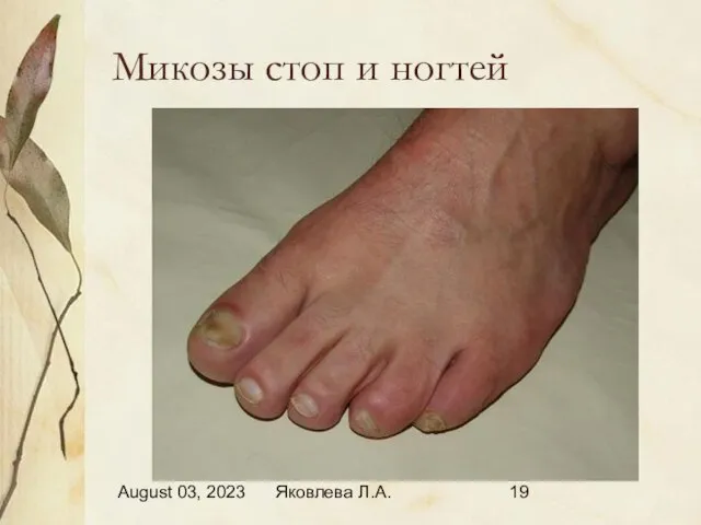 August 03, 2023 Яковлева Л.А. Микозы стоп и ногтей