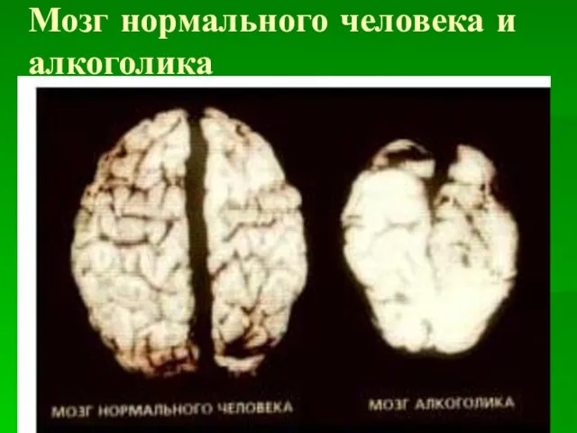 Мозг нормального человека и алкоголика