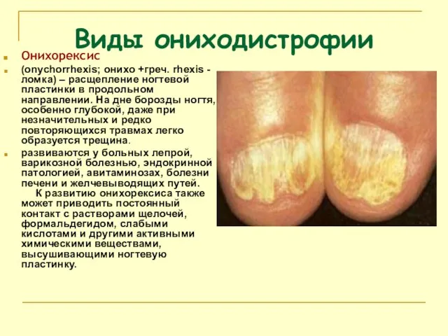 Виды ониходистрофии Онихорексис (onychorrhexis; онихо +греч. rhexis - ломка) – расщепление ногтевой