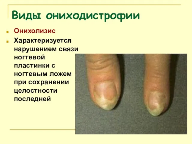 Виды ониходистрофии Онихолизис Характеризуется нарушением связи ногтевой пластинки с ногтевым ложем при сохранении целостности последней