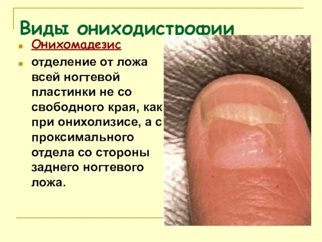 Виды ониходистрофии Онихомадезис отделение от ложа всей ногтевой пластинки не со свободного