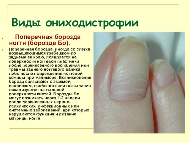 Виды ониходистрофии Поперечная борозда ногтя (борозда Бо). Поперечная борозда, иногда со слегка