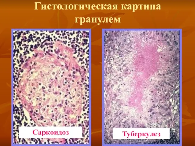 Гистологическая картина гранулем Саркоидоз Туберкулез