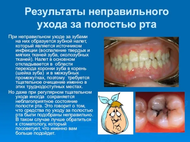 Результаты неправильного ухода за полостью рта При неправильном уходе за зубами на