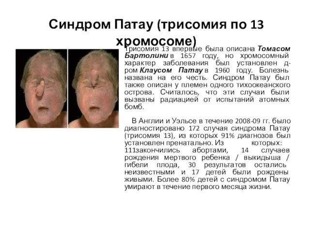 Синдром Патау (трисомия по 13 хромосоме) Трисомия 13 впервые была описана Томасом