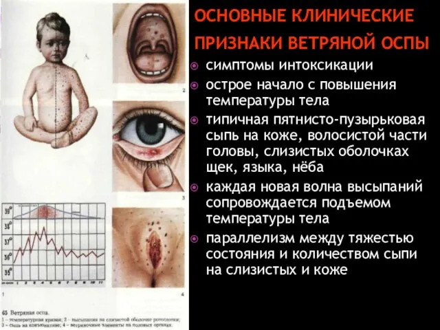 ОСНОВНЫЕ КЛИНИЧЕСКИЕ ПРИЗНАКИ ВЕТРЯНОЙ ОСПЫ симптомы интоксикации острое начало с повышения температуры