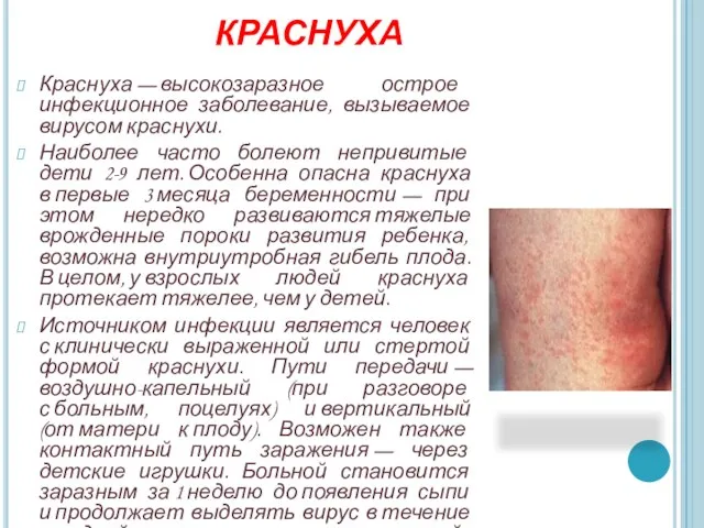Краснуха Краснуха — высокозаразное острое инфекционное заболевание, вызываемое вирусом краснухи. Наиболее часто