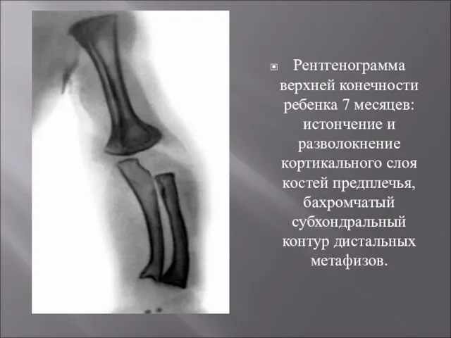 Рентгенограмма верхней конечности ребенка 7 месяцев: истончение и разволокнение кортикального слоя костей