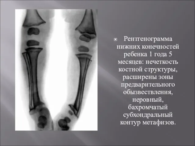Рентгенограмма нижних конечностей ребенка 1 года 5 месяцев: нечеткость костной структуры, расширены
