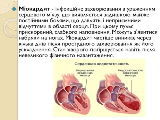 Міокардит - інфекційне захворювання з ураженням серцевого м'язу, що виявляється задишкою, майже