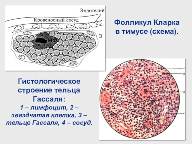 Фолликул Кларка в тимусе (схема). Гистологическое строение тельца Гассаля: 1 – лимфоцит,