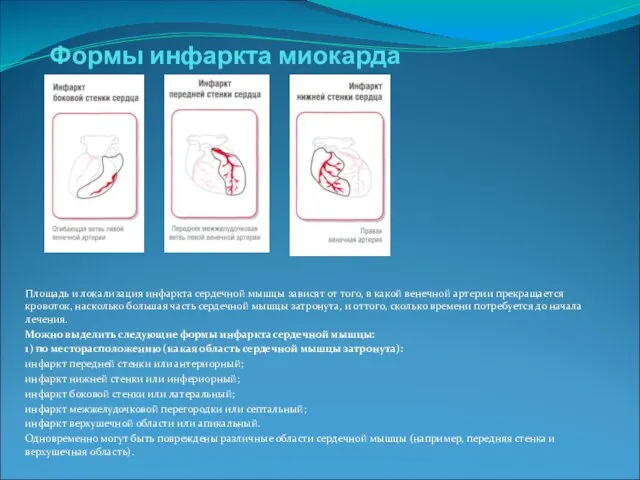 Формы инфаркта миокарда Площадь и локализация инфаркта сердечной мышцы зависят от того,