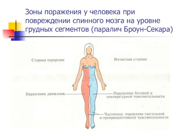 Зоны поражения у человека при повреждении спинного мозга на уровне грудных сегментов (паралич Броун-Секара)