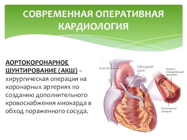 СОВРЕМЕННАЯ ОПЕРАТИВНАЯ КАРДИОЛОГИЯ АОРТОКОРОНАРНОЕ ШУНТИРОВАНИЕ (АКШ) – хирургическая операция на коронарных артериях