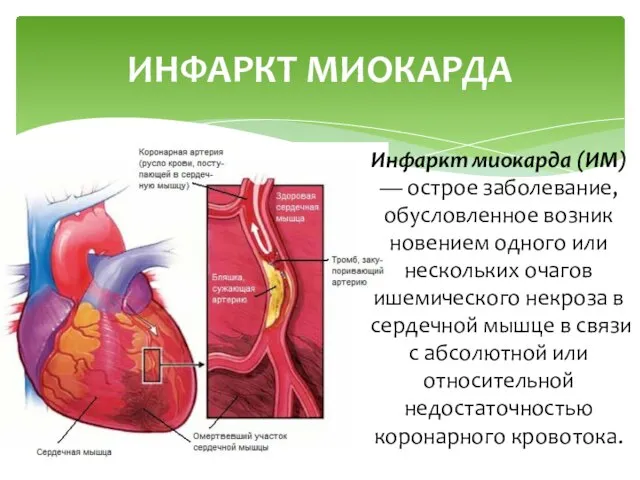 Инфаркт миокарда (ИМ) — острое заболевание, обусловленное возник­новением одного или нескольких очагов