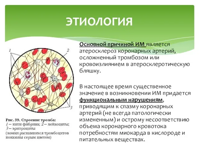 Основной причиной ИМ является атеросклероз коронарных артерий, осложненный тромбозом или кровоизлиянием в