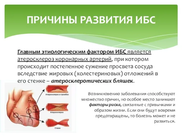 ПРИЧИНЫ РАЗВИТИЯ ИБС Главным этиологическим фактором ИБС является атеросклероз коро­нарных артерий, при