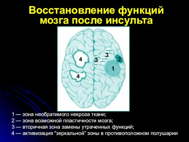 Восстановление функций мозга после инсульта 1 — зона необратимого некроза ткани; 2