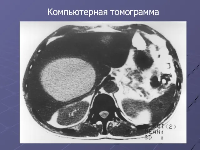 Компьютерная томограмма