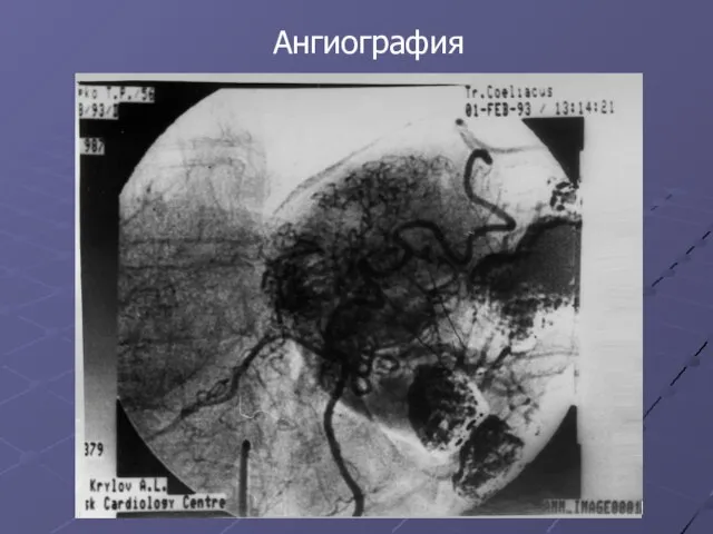 Ангиография