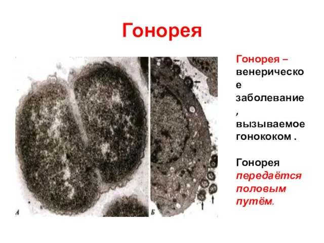 Гонорея Гонорея – венерическое заболевание, вызываемое гонококом . Гонорея передаётся половым путём.