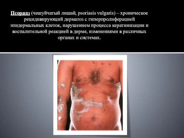 Псориаз (чешуйчатый лишай, psoriasis vulgaris) – хроническое рецидивирующий дерматоз с гиперпролиферацией эпидермальных