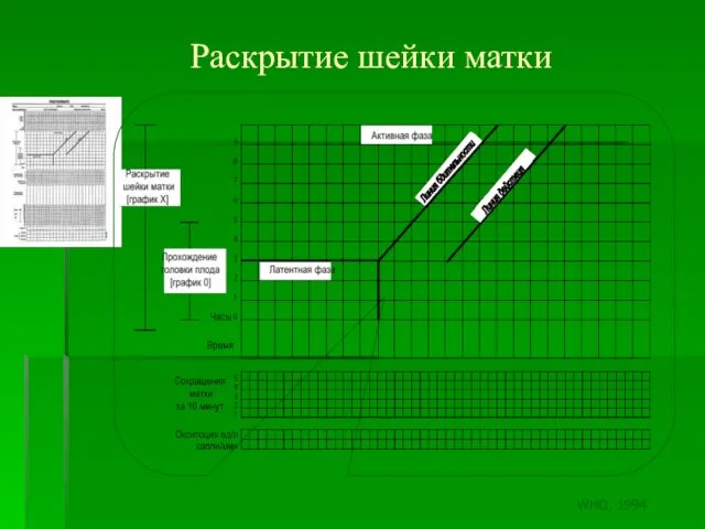 Раскрытие шейки матки Линия бдительности Линия действия WHO, 1994