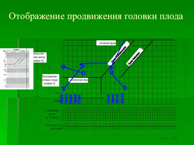 13:00 14:00 15:00 16:00 17:00 Отображение продвижения головки плода Линия бдительности Линия действия WHO, 1994