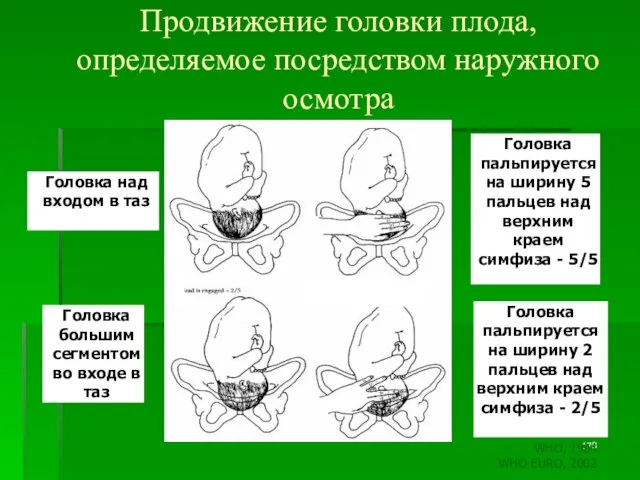 Продвижение головки плода, определяемое посредством наружного осмотра Головка над входом в таз