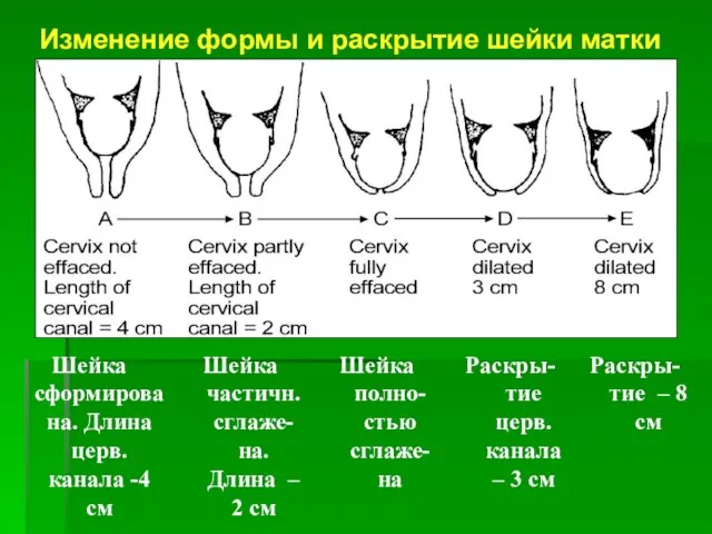 Изменение формы и раскрытие шейки матки