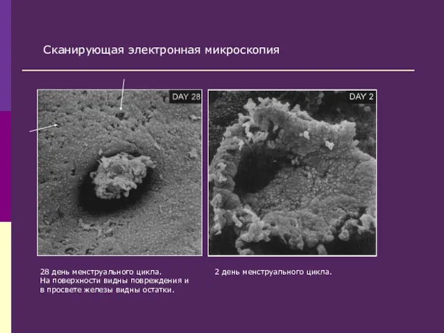 28 день менструального цикла. На поверхности видны повреждения и в просвете железы