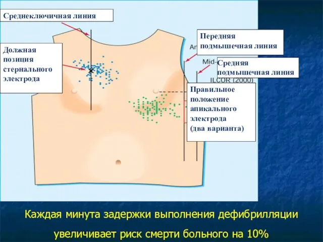 Каждая минута задержки выполнения дефибрилляции увеличивает риск смерти больного на 10% Среднеключичная