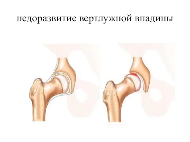 недоразвитие вертлужной впадины